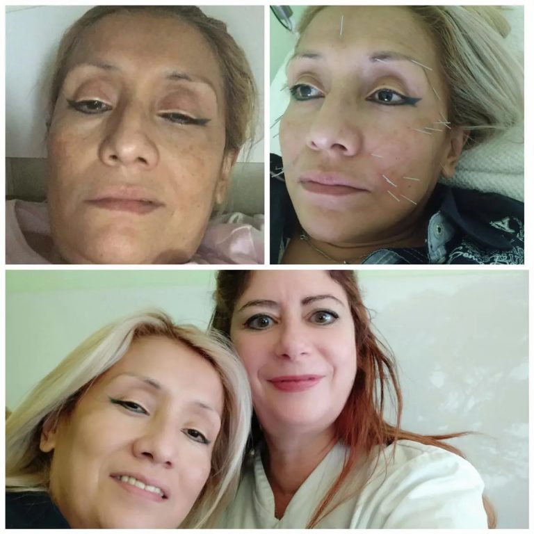 paralisis facial acupuntura marta