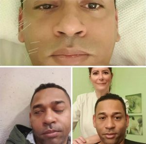 paralisis-facial-acupuntura-miguel