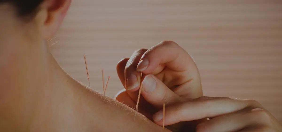 acupuntura contracturas Madrid