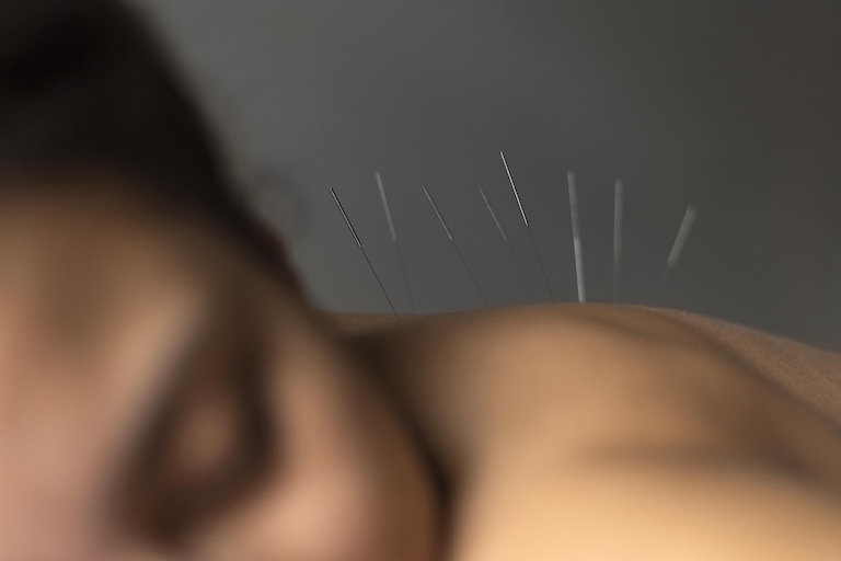dolor crónico y acupuntura