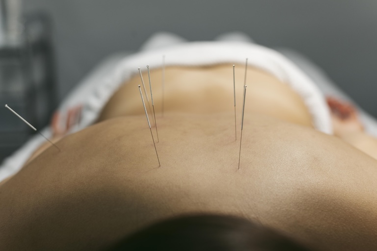 efectos de la acupuntura en el sistema nervioso
