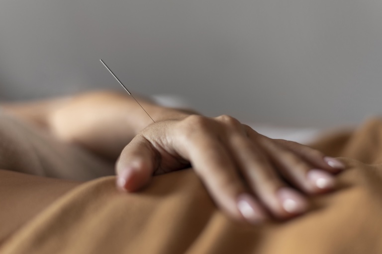qué es y para qué sirve la acupuntura